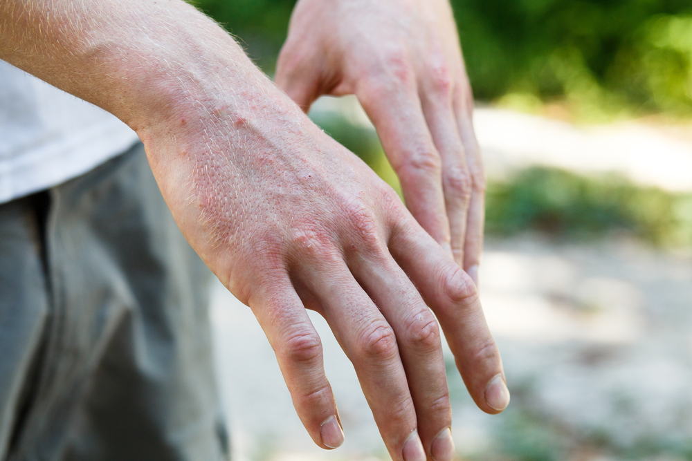 how-to-tell-if-you-re-allergic-to-silicone-silicone-rings